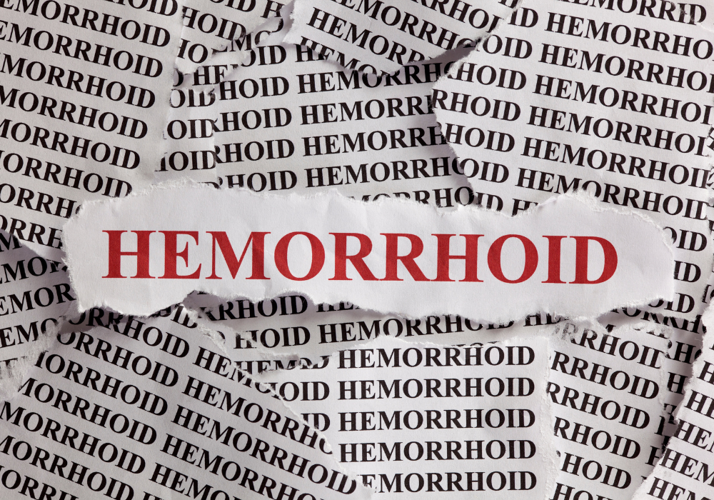 Descubrir el alivio Ensayos clínicos para las hemorroides+